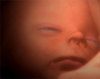 Tortura intrauterina